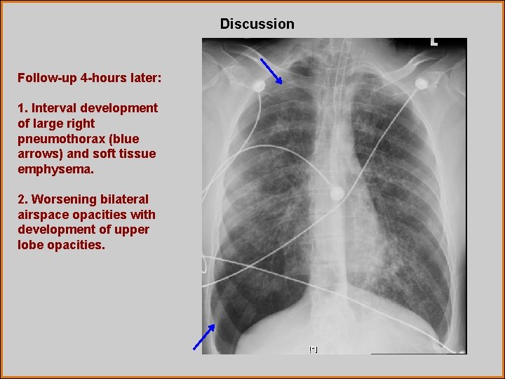 Discussion Follow-up 4 -hours later: 1. Interval development of large right pneumothorax (blue arrows)