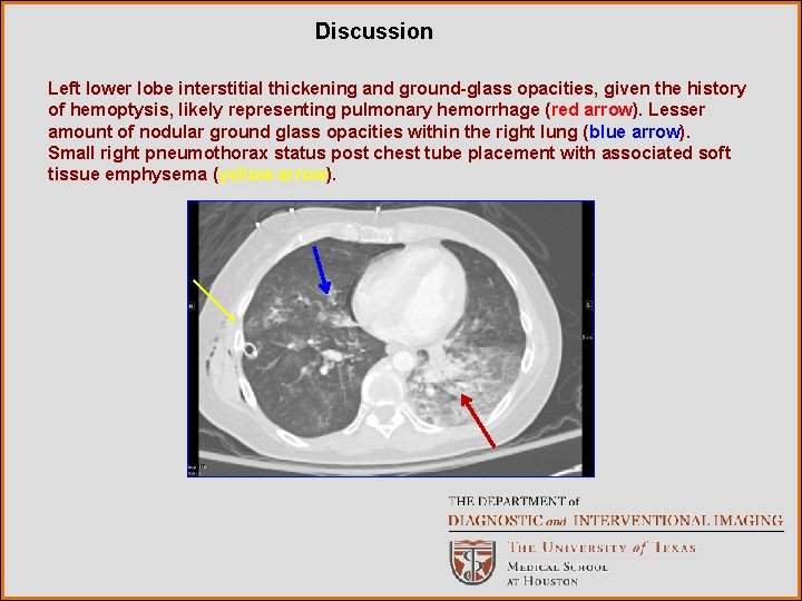 Discussion Left lower lobe interstitial thickening and ground-glass opacities, given the history of hemoptysis,