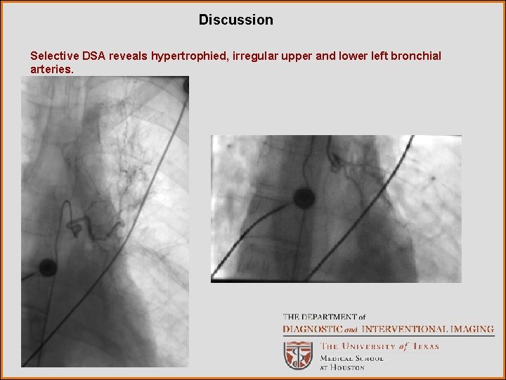 Discussion Selective DSA reveals hypertrophied, irregular upper and lower left bronchial arteries. 