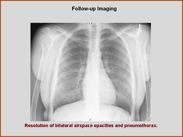 Follow-up Imaging Resolution of bilateral airspace opacities and pneumothorax. 