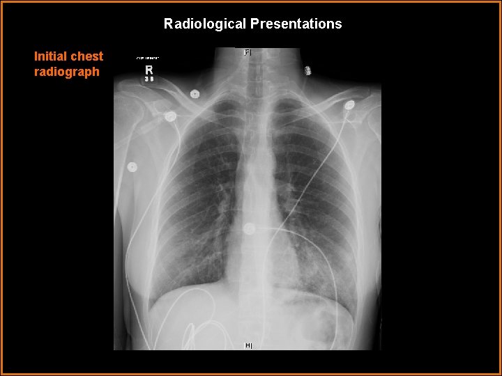 Radiological Presentations Initial chest radiograph 