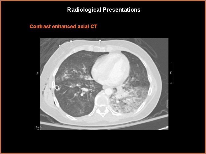 Radiological Presentations Contrast enhanced axial CT 