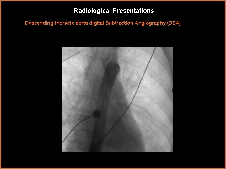 Radiological Presentations Descending thoracic aorta digital Subtraction Angiography (DSA) 