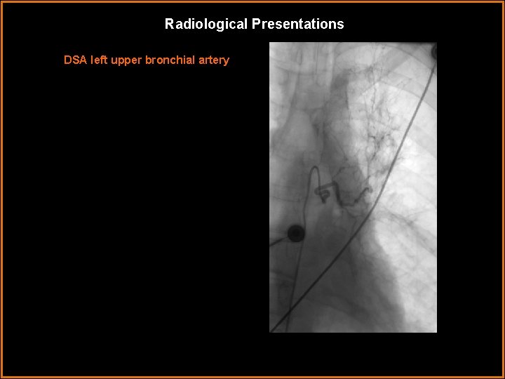 Radiological Presentations DSA left upper bronchial artery 