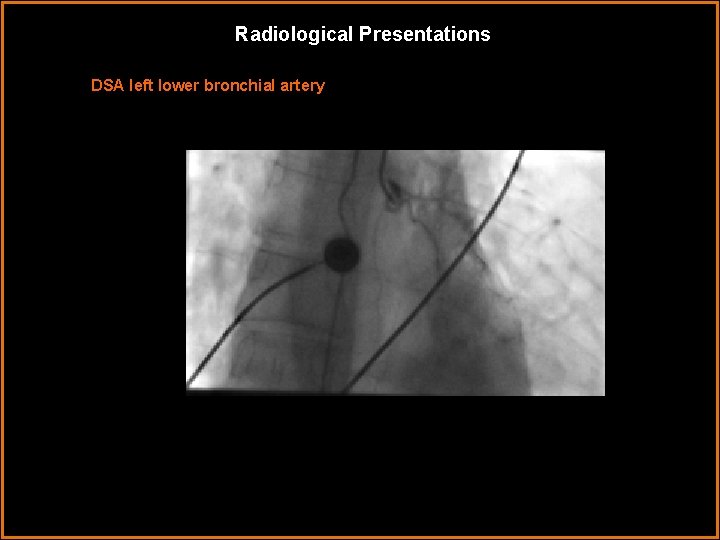 Radiological Presentations DSA left lower bronchial artery 