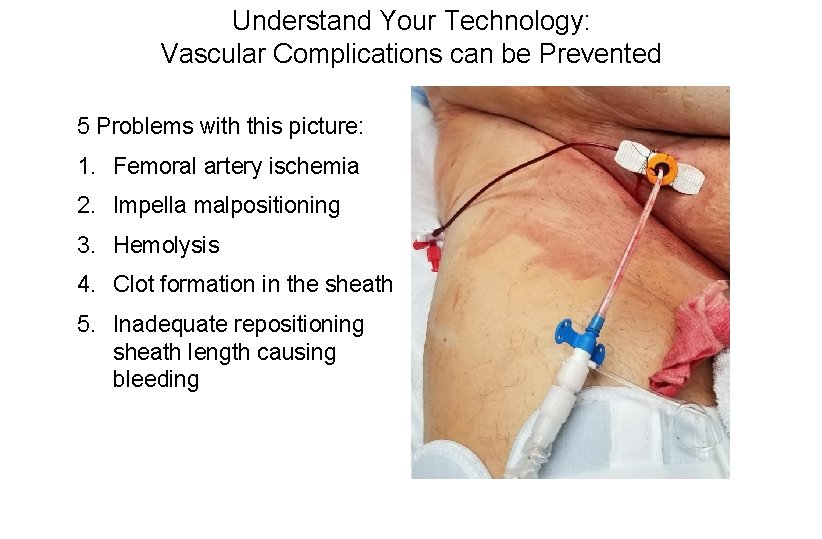 Understand Your Technology: Vascular Complications can be Prevented 5 Problems with this picture: 1.