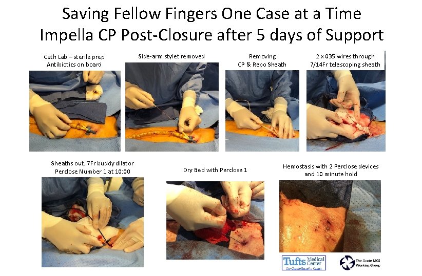 Saving Fellow Fingers One Case at a Time Impella CP Post-Closure after 5 days