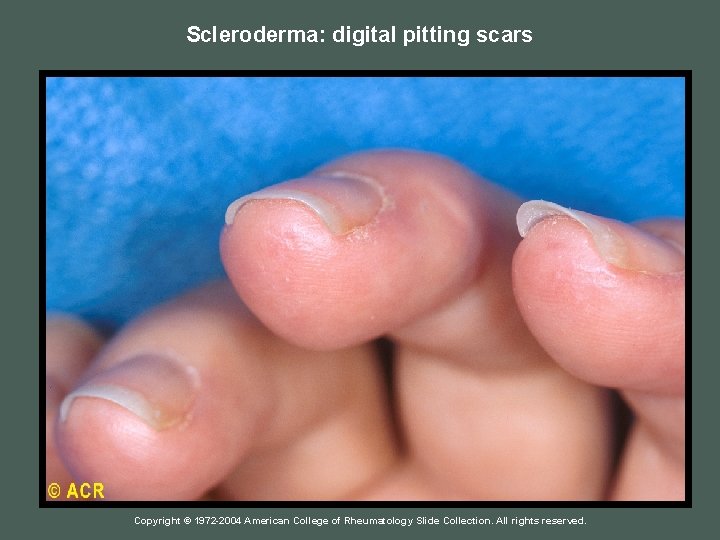 Scleroderma: digital pitting scars Copyright © 1972 -2004 American College of Rheumatology Slide Collection.