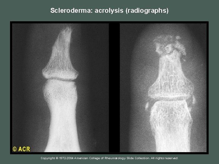 Scleroderma: acrolysis (radiographs) Copyright © 1972 -2004 American College of Rheumatology Slide Collection. All