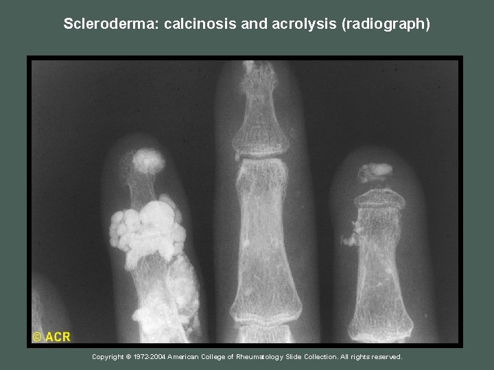Scleroderma: calcinosis and acrolysis (radiograph) Copyright © 1972 -2004 American College of Rheumatology Slide
