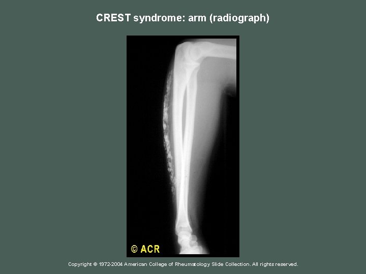 CREST syndrome: arm (radiograph) Copyright © 1972 -2004 American College of Rheumatology Slide Collection.