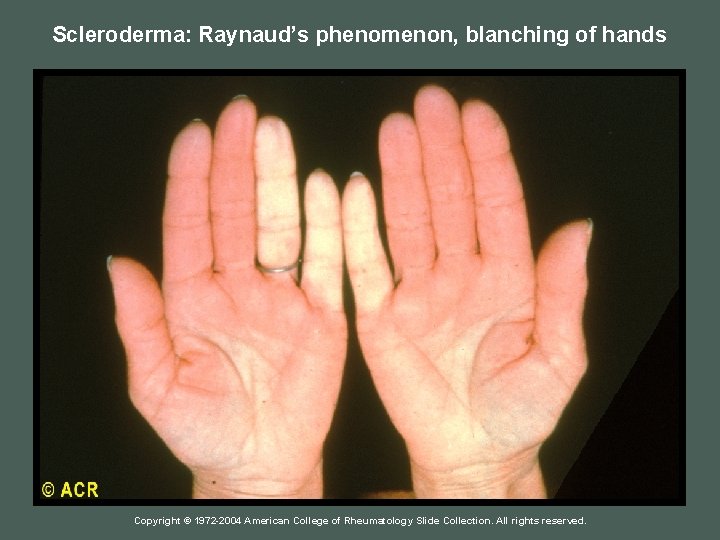 Scleroderma: Raynaud’s phenomenon, blanching of hands Copyright © 1972 -2004 American College of Rheumatology