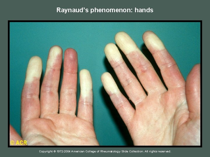 Raynaud’s phenomenon: hands Copyright © 1972 -2004 American College of Rheumatology Slide Collection. All