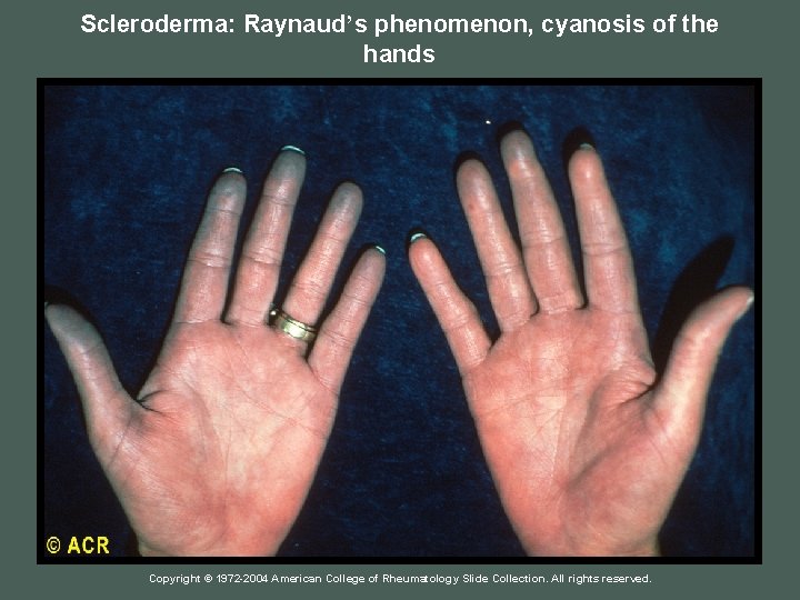 Scleroderma: Raynaud’s phenomenon, cyanosis of the hands Copyright © 1972 -2004 American College of