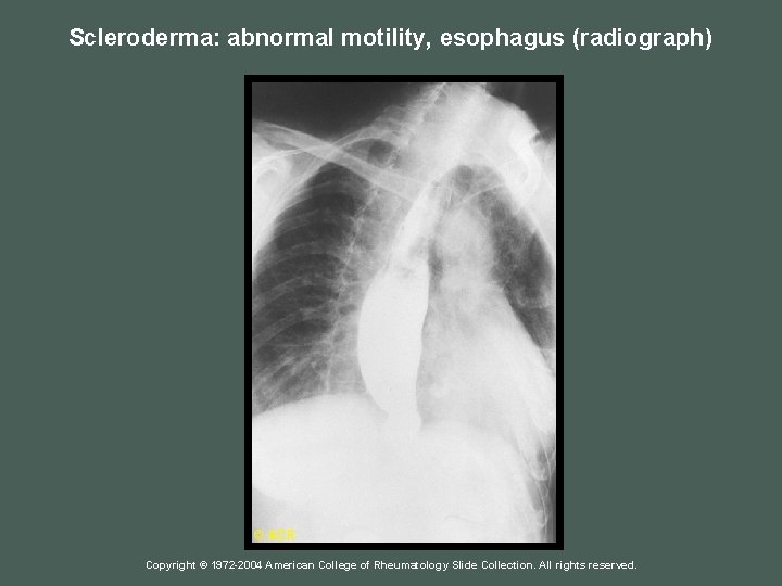 Scleroderma: abnormal motility, esophagus (radiograph) Copyright © 1972 -2004 American College of Rheumatology Slide