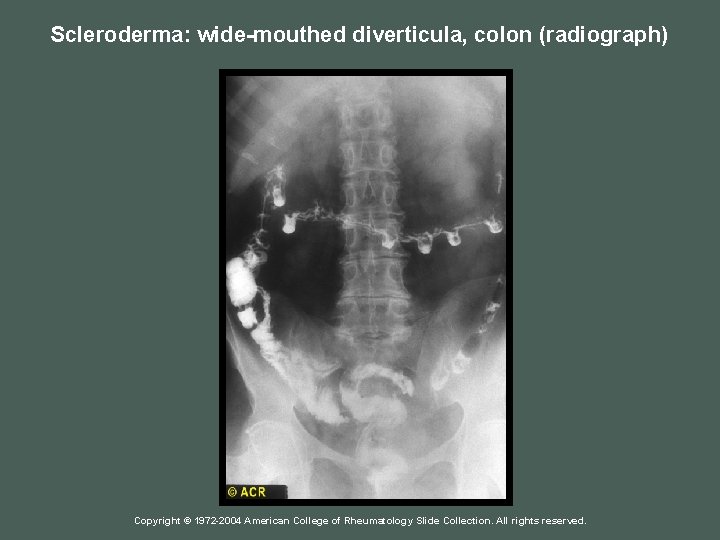 Scleroderma: wide-mouthed diverticula, colon (radiograph) Copyright © 1972 -2004 American College of Rheumatology Slide