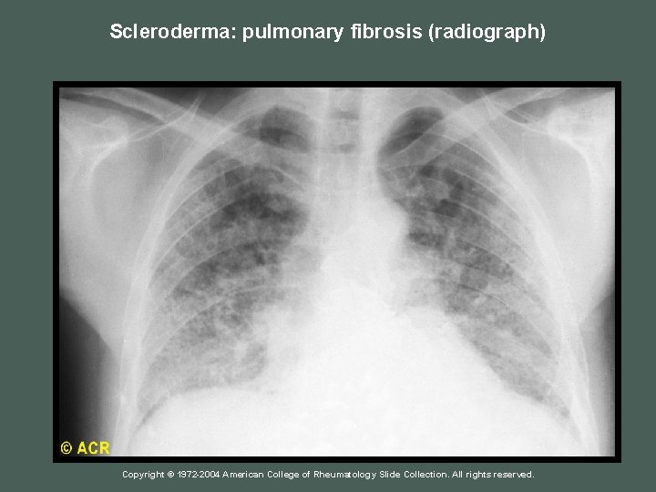 Scleroderma: pulmonary fibrosis (radiograph) Copyright © 1972 -2004 American College of Rheumatology Slide Collection.