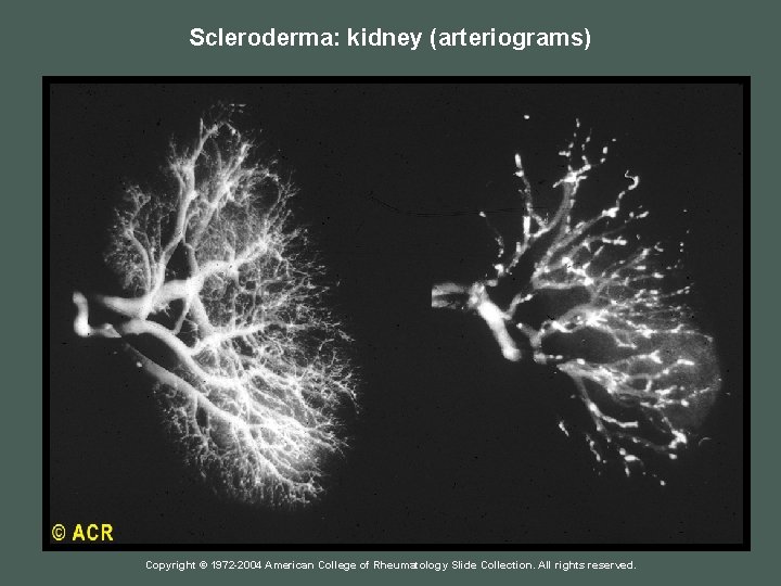 Scleroderma: kidney (arteriograms) Copyright © 1972 -2004 American College of Rheumatology Slide Collection. All