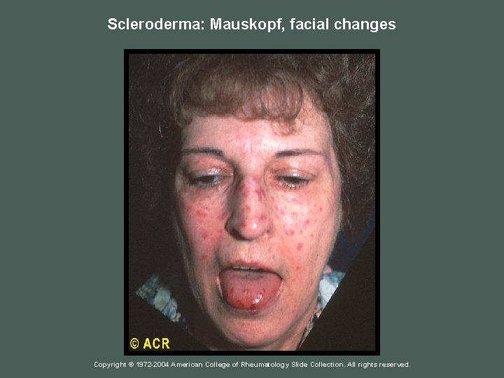 Scleroderma: Mauskopf, facial changes Copyright © 1972 -2004 American College of Rheumatology Slide Collection.