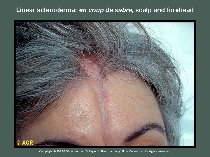 Linear scleroderma: en coup de sabre, scalp and forehead Copyright © 1972 -2004 American