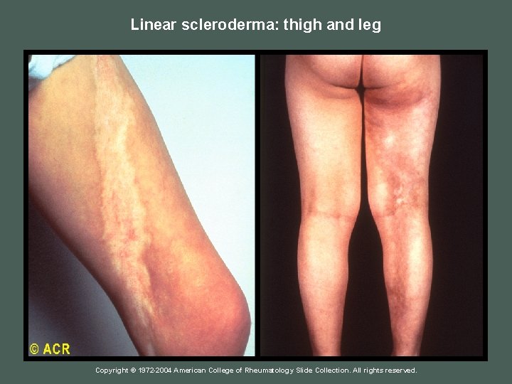 Linear scleroderma: thigh and leg Copyright © 1972 -2004 American College of Rheumatology Slide