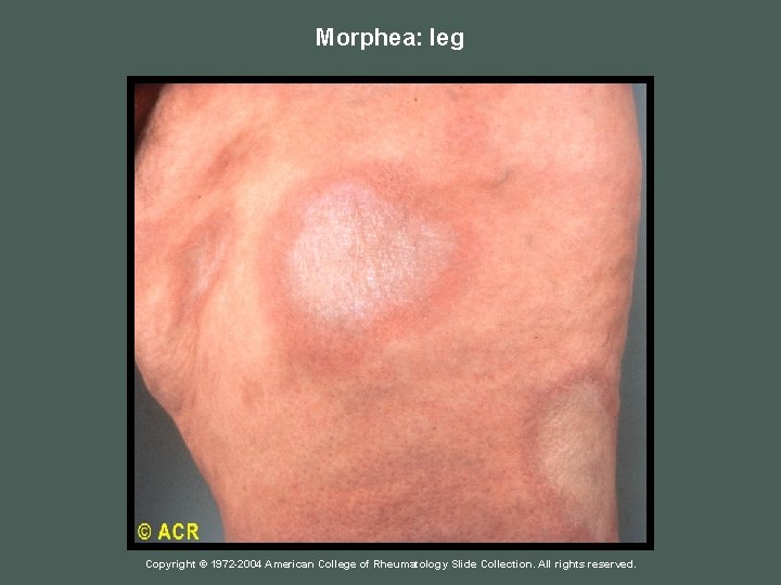 Morphea: leg Copyright © 1972 -2004 American College of Rheumatology Slide Collection. All rights