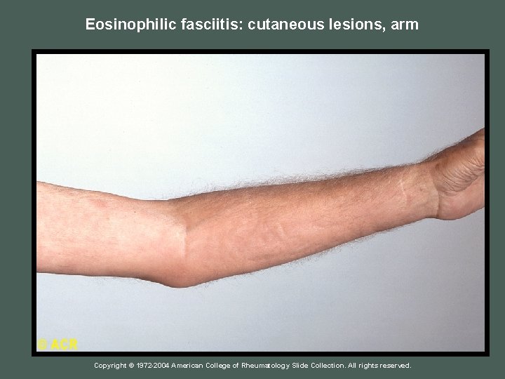 Eosinophilic fasciitis: cutaneous lesions, arm Copyright © 1972 -2004 American College of Rheumatology Slide