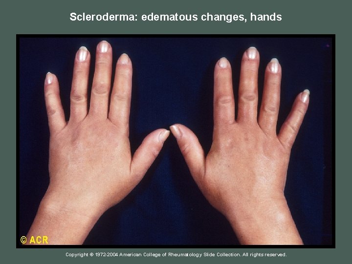 Scleroderma: edematous changes, hands Copyright © 1972 -2004 American College of Rheumatology Slide Collection.
