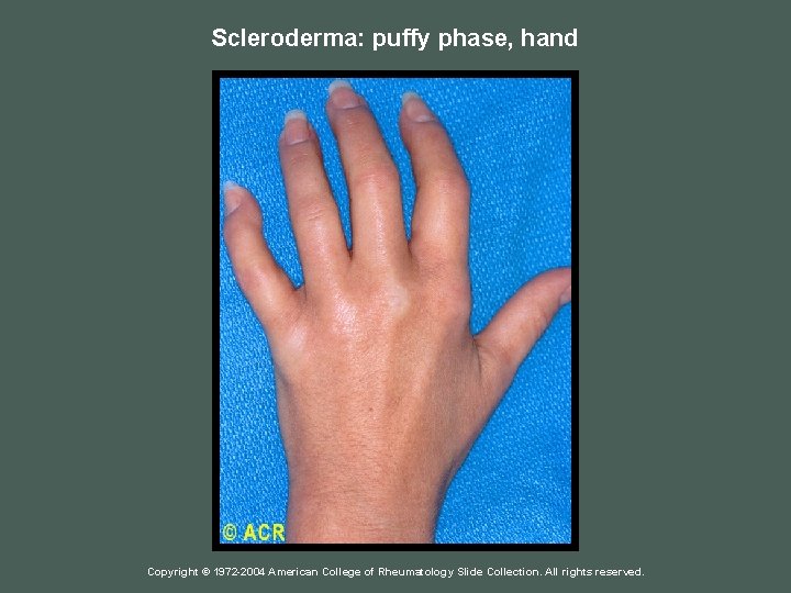 Scleroderma: puffy phase, hand Copyright © 1972 -2004 American College of Rheumatology Slide Collection.