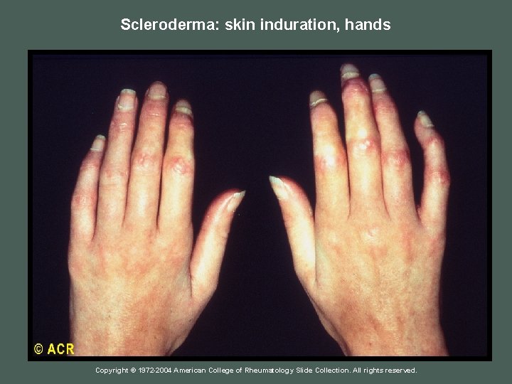 Scleroderma: skin induration, hands Copyright © 1972 -2004 American College of Rheumatology Slide Collection.