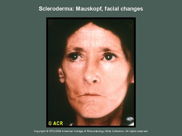 Scleroderma: Mauskopf, facial changes Copyright © 1972 -2004 American College of Rheumatology Slide Collection.