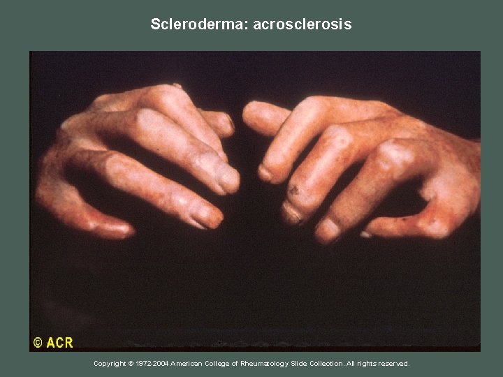 Scleroderma: acrosclerosis Copyright © 1972 -2004 American College of Rheumatology Slide Collection. All rights