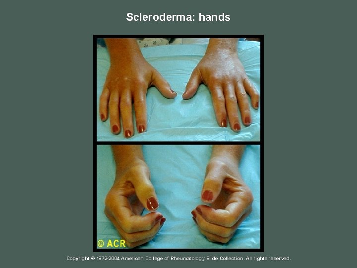 Scleroderma: hands Copyright © 1972 -2004 American College of Rheumatology Slide Collection. All rights