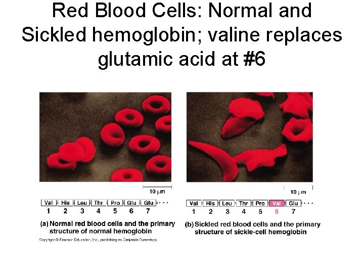 Red Blood Cells: Normal and Sickled hemoglobin; valine replaces glutamic acid at #6 