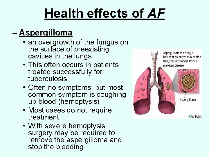 Health effects of AF – Aspergilloma • an overgrowth of the fungus on the