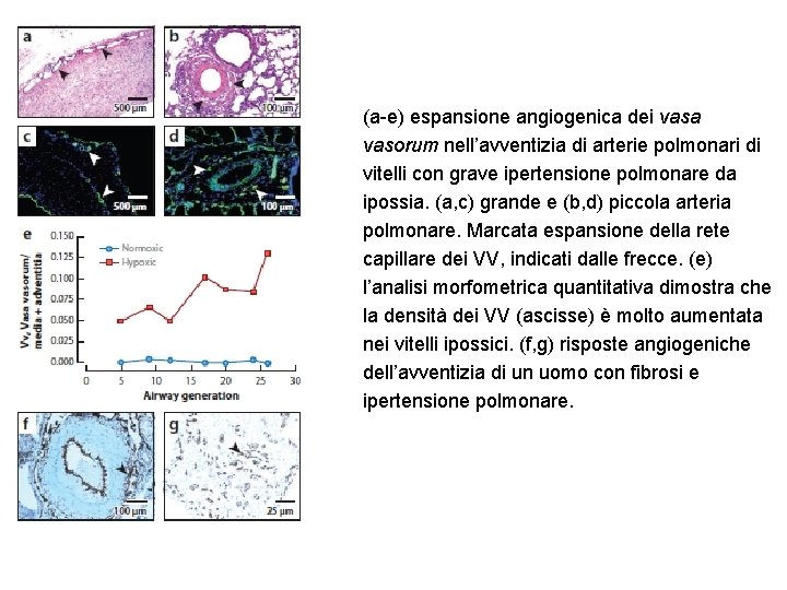 (a-e) espansione angiogenica dei vasa vasorum nell’avventizia di arterie polmonari di vitelli con grave