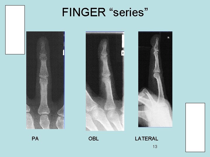 FINGER “series” PA OBL LATERAL 13 