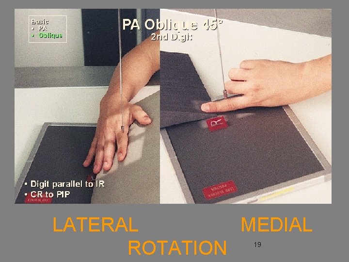  LATERAL MEDIAL ROTATION 19 