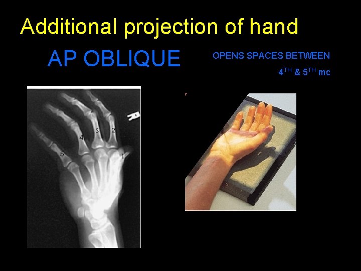 Additional projection of hand AP OBLIQUE OPENS SPACES BETWEEN 4 & 5 mc TH
