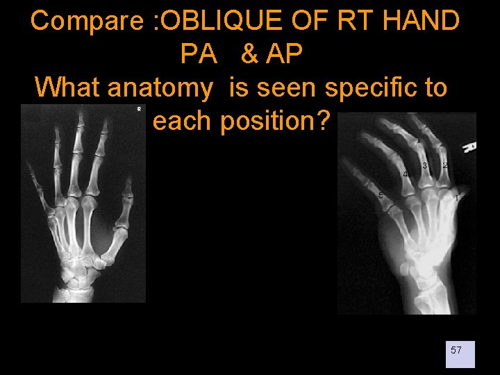  Compare : OBLIQUE OF RT HAND PA & AP What anatomy is seen