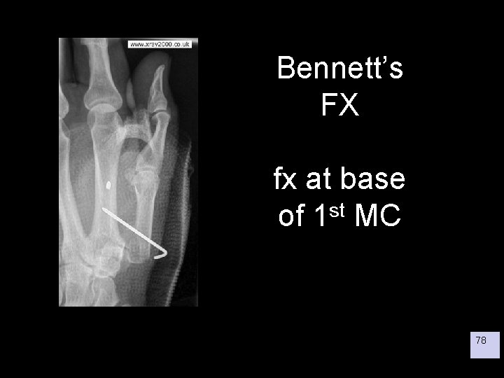 Bennett’s FX fx at base of 1 st MC 78 