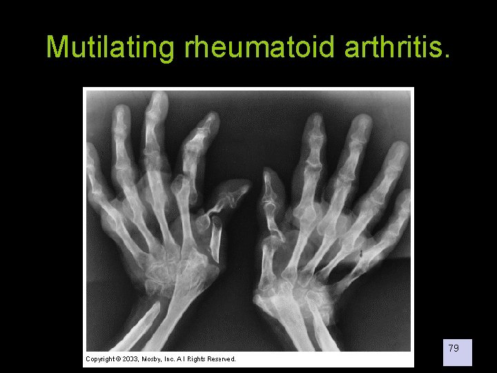 Mutilating rheumatoid arthritis. 79 