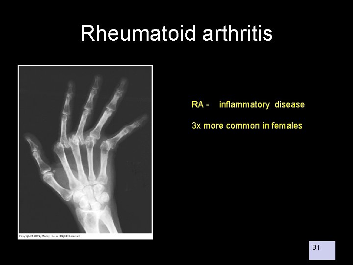Rheumatoid arthritis RA - inflammatory disease 3 x more common in females 81 