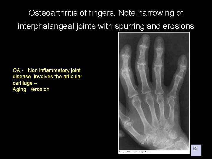 Osteoarthritis of fingers. Note narrowing of interphalangeal joints with spurring and erosions OA -