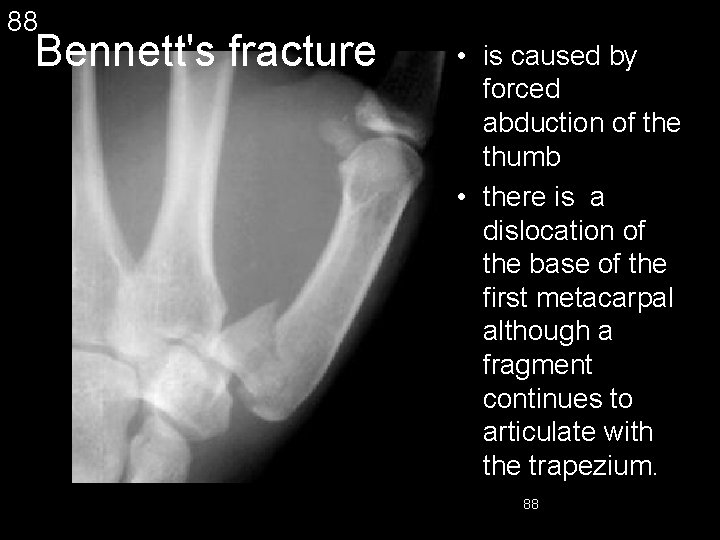 88 Bennett's fracture • is caused by forced abduction of the thumb • there