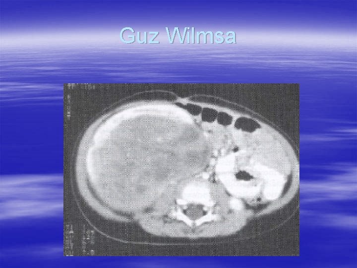 Guz Wilmsa 