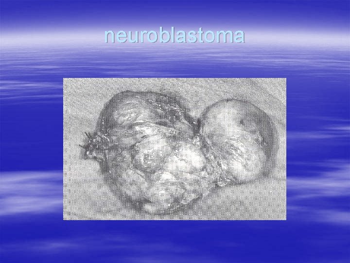 neuroblastoma 