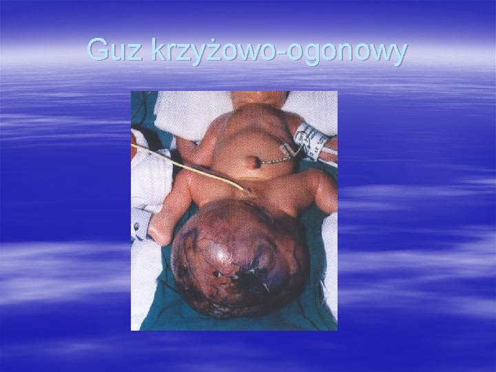 Guz krzyżowo-ogonowy 