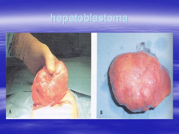 hepatoblastoma 