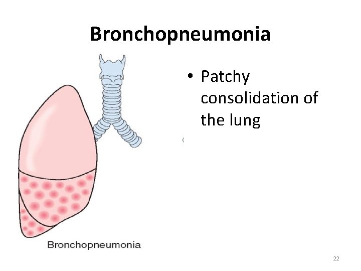 Bronchopneumonia • Patchy consolidation of the lung 22 